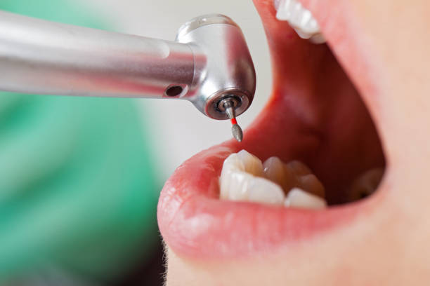 Best Emergency Wisdom Teeth Removal in Franconia, VA